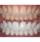 Best Teeth Whitening Strips, 3 Treatments, Movie Star White Teeth, Super Bright Formula, Lasts