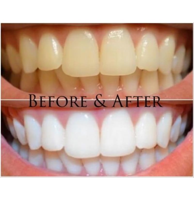 Best Teeth Whitening Strips, 3 Treatments, Movie Star White Teeth, Super Bright Formula, Lasts